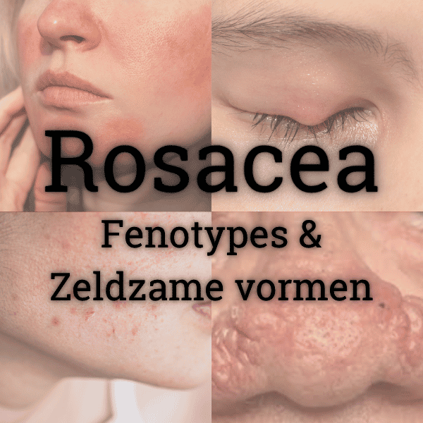 Rosacea 'bijbel' alle fenotypes en zeldzame vormen wetenschappelijk ontrafeld