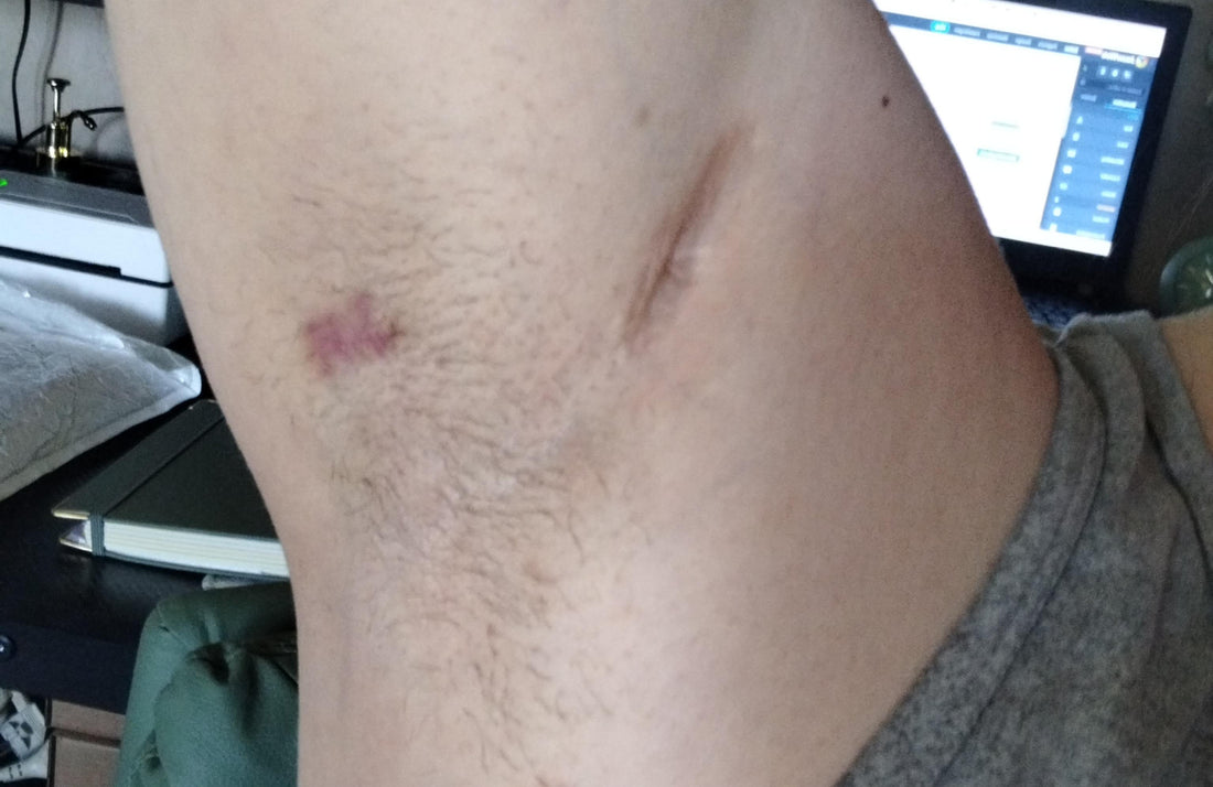 De Rauwe Waarheid over Hidradenitis Suppurativa (HS): Pijn, Schaamte en de Weg naar Huidrust