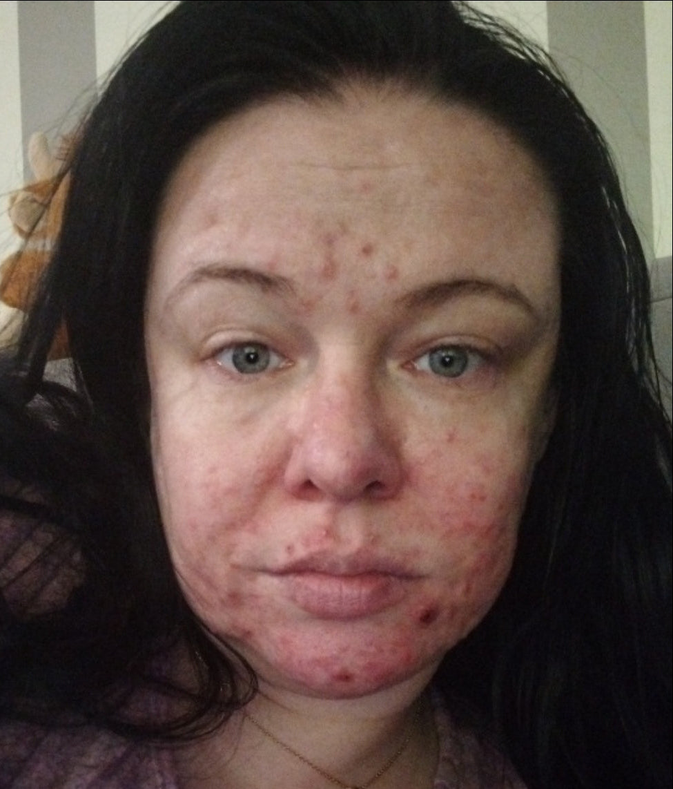 Als je Rosacea hebt, ben je al die loze beloftes spuugzat. (En dit is wat wél werkt)