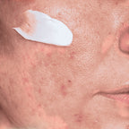 Mimos soap and more Flare-Up Sun Block SPF 30, een minerale zonnebrandcrème met witte lotion op een huid met roodheid en puistjes.